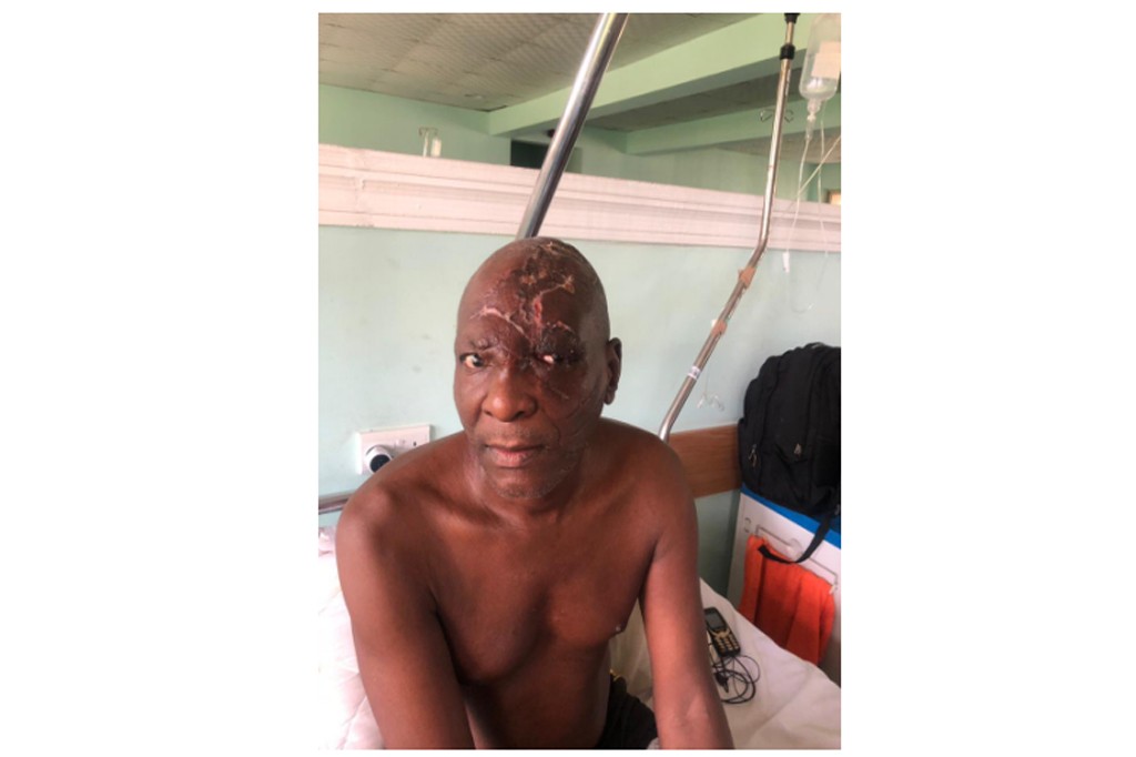 After successful Surgery